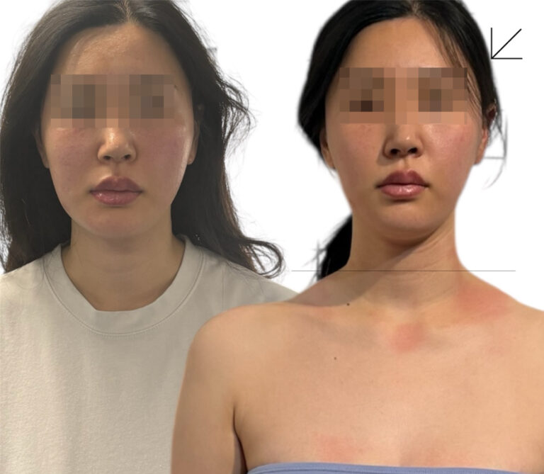 얼굴비대칭 비수술 케어 칼럼 대표 이미지