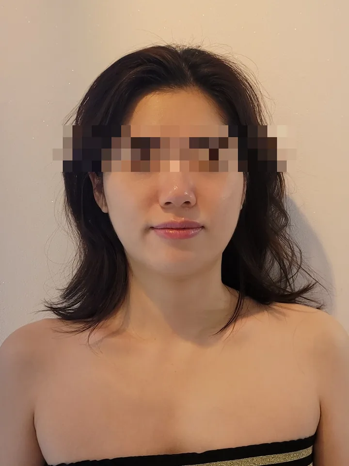 얼굴비대칭 케어 후: 얼굴 기울기가 줄고 턱 라인이 세로로 정돈된 정면 사진