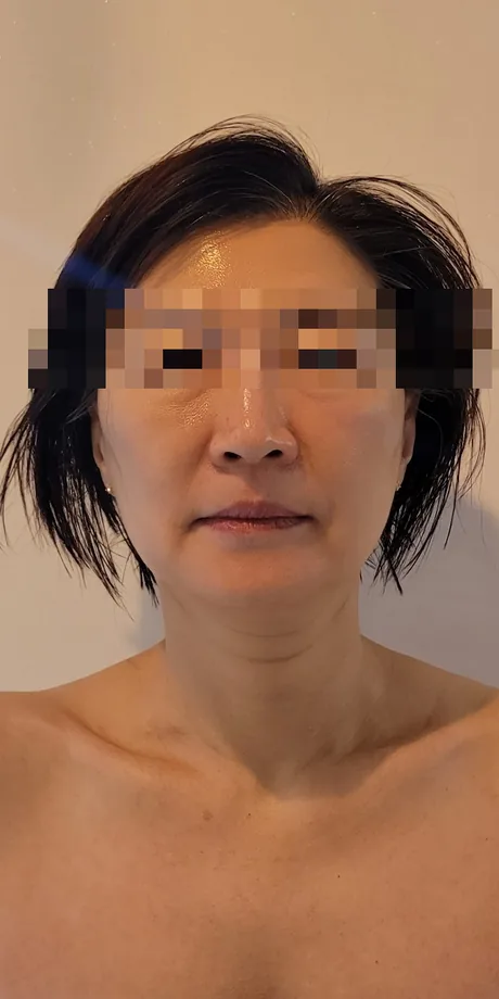 얼굴비대칭 케어 후: 얼굴형과 좌우 균형이 정돈된 정면 사진