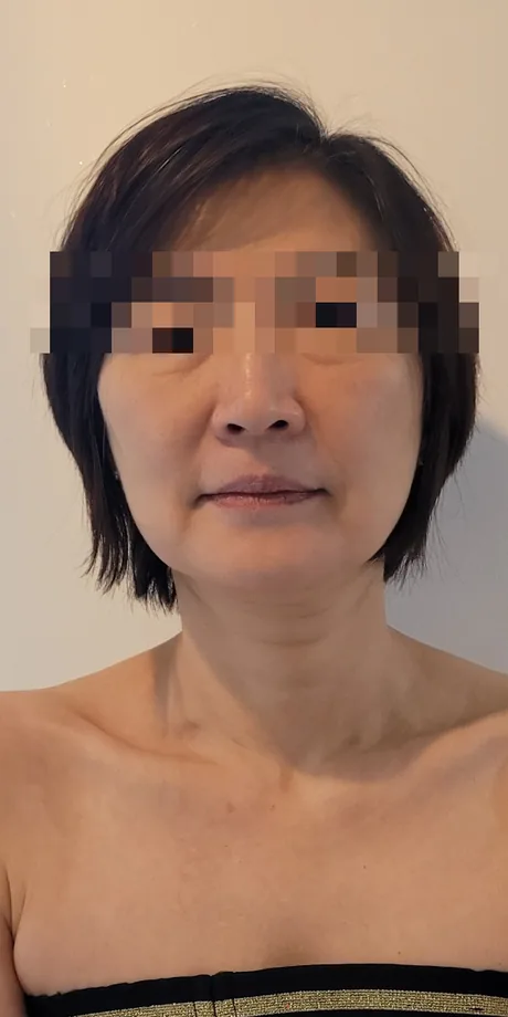 얼굴비대칭 케어 전: 좌우 볼과 턱선이 달라 보이는 정면 사진