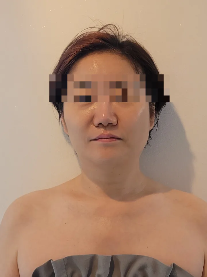 얼굴비대칭 케어 후: 볼과 턱선이 정리되고 좌우 균형이 맞춰진 정면 사진