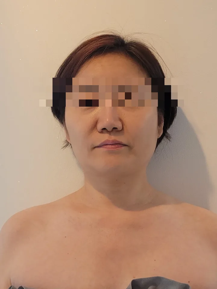 얼굴비대칭 케어 전: 볼과 턱선이 무겁고 좌우 볼 크기가 달라 보이는 정면 사진