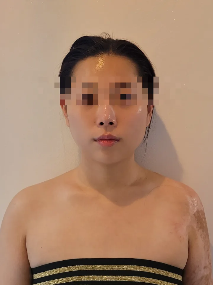 얼굴비대칭 케어 후: 좌우 볼 볼륨이 고르게 정리되어 대칭이 개선된 정면 사진