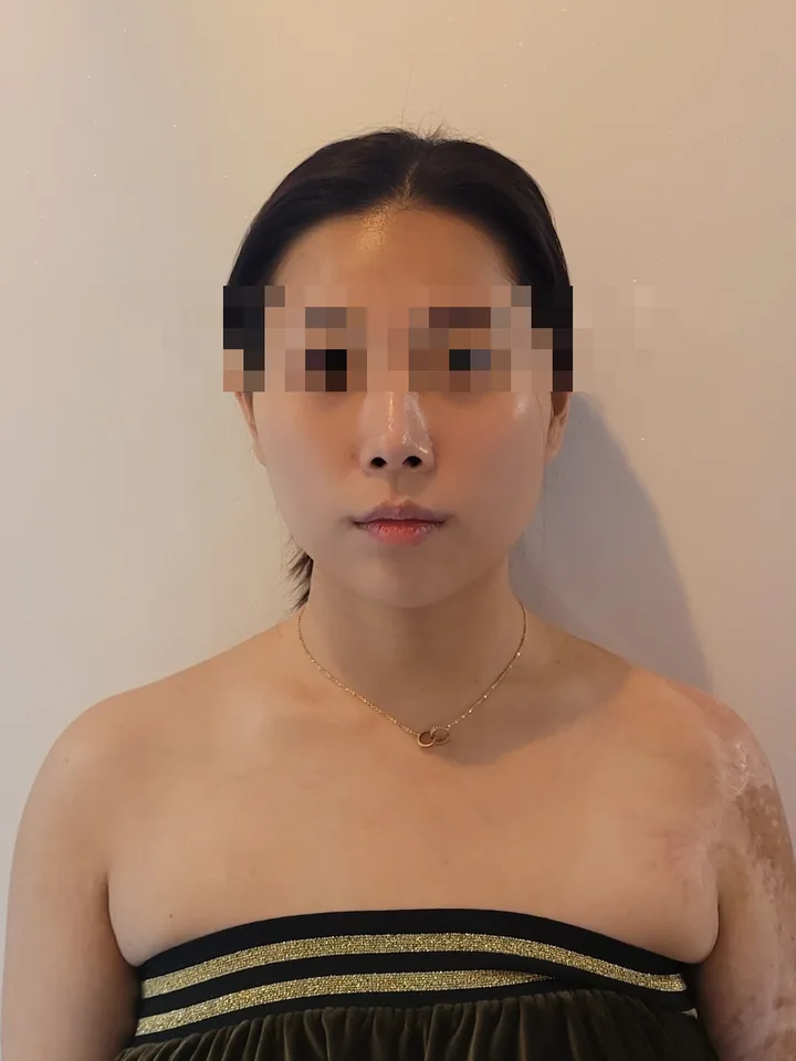 얼굴비대칭 케어 전: 한쪽 볼과 광대가 도드라져 좌우 폭이 다른 정면 사진