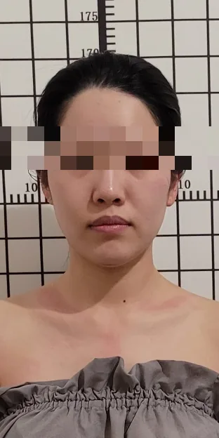얼굴비대칭 케어 후: 붓기가 빠지고 얼굴형이 정리된 정면 사진