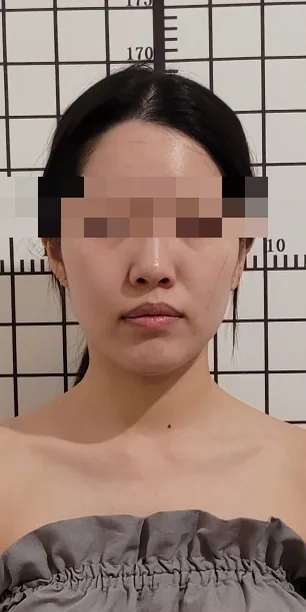 얼굴비대칭 케어 전: 볼이 부어 얼굴이 커 보이는 정면 사진