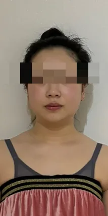 좌우 균형 케어 후 — 좌우가 고르게 정돈된 정면 사진