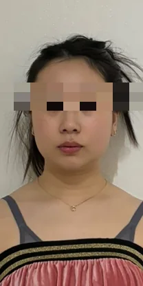좌우 균형 케어 전 — 얼굴이 한쪽으로 치우쳐 보이는 정면 사진