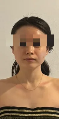 얼굴 라인 케어 후 — 붓기가 정리되고 좌우 균형이 고르게 맞춰진 정면 사진