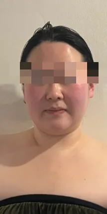 얼굴형 케어 후 — 볼·턱선이 정리되고 갸름해진 정면 사진