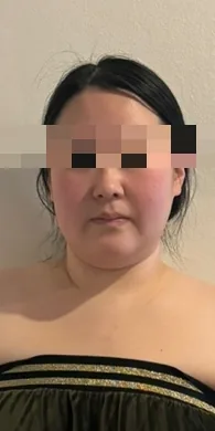 얼굴형 케어 전 — 볼·턱선이 무거운 정면 사진