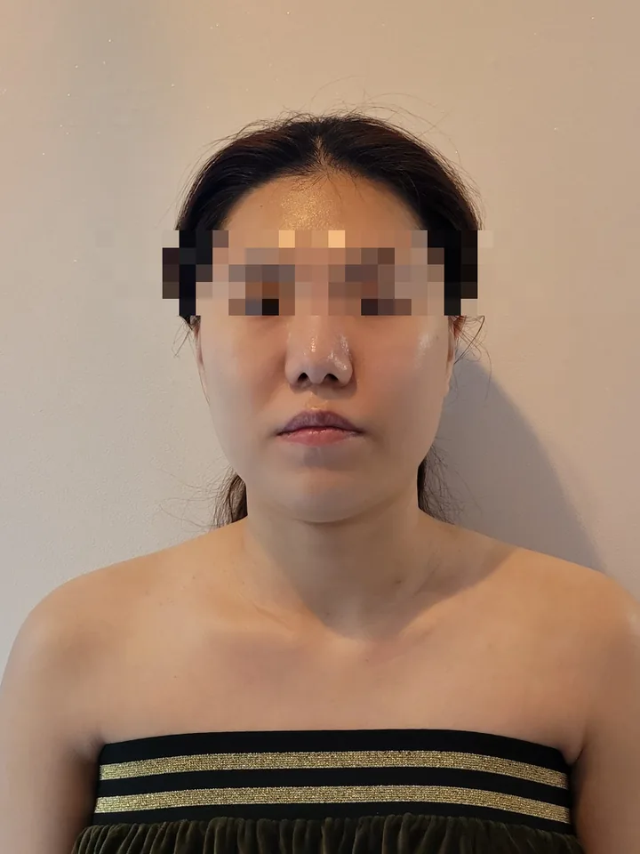 얼굴비대칭 케어 2회차 후: 볼 볼륨이 줄고 턱선이 드러나 얼굴형이 갸름해진 정면 사진