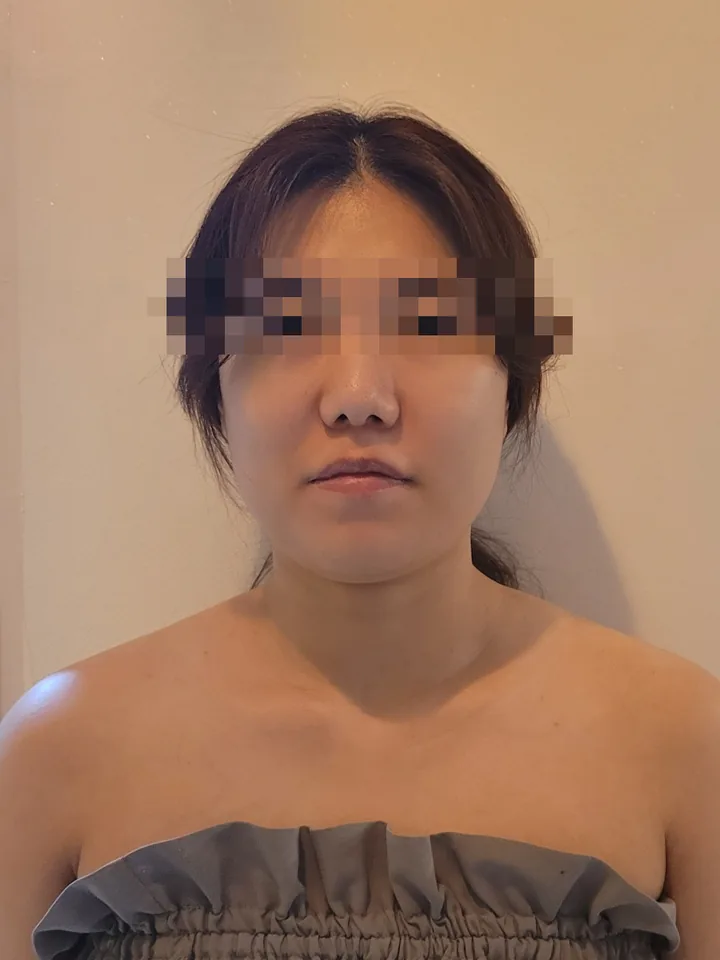 얼굴비대칭 케어 전: 볼 볼륨과 붓기로 얼굴이 넓고 커 보이는 정면 사진